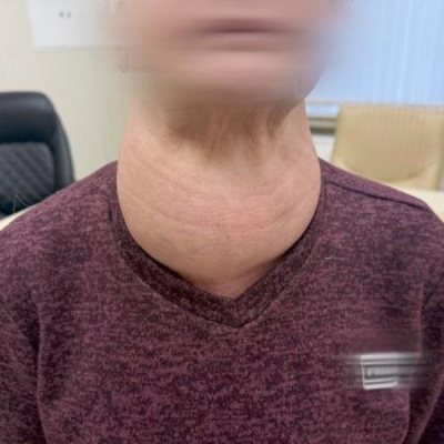 В Татарстане хирурги удалили пациентке гигантскую щитовидную железу размером с голову